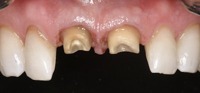 Preparation image of the incisors