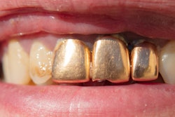 2020 01 29 23 10 7673 Teeth Gold 400