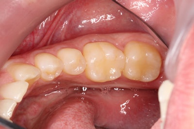 Preoperative photo shows a fracture on the distal lingual aspect of an existing composite restoration on tooth #19. All images courtesy of Dr. Greg Campbell.
