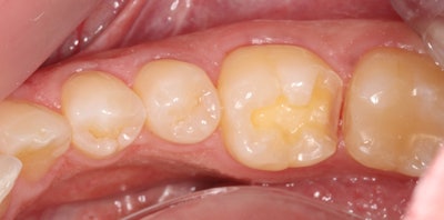 Final preparation shown used fine diamonds to eliminate undercuts to ensure that it would draw.