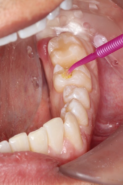 Clearfil Universal Bond Quick was applied to the dentin and enamel for a few seconds and air dried until solvents were evaporated