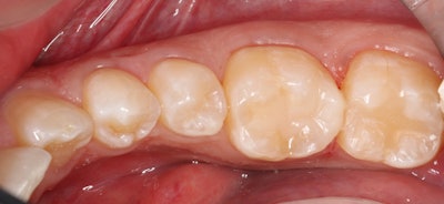 The final restoration.