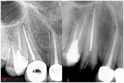 Diagnostic radiography (a) before and (b) after removal of the metal ceramic crown. All images courtesy of Mothanna AlRahabi, PhD, and Hani Ghabbani, BDS. Licensed under CC BY-NC 4.0.