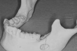 2020 03 27 19 55 5598 2020 03 30 Migrated Bur Thumb 20200327190313