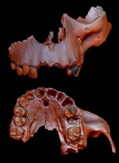 Digital reconstruction, which was done using computerized microtomography, of a specimen from the H. antecessor collection. Image courtesy of Laura Martín-Francés, PhD, of the University of Bordeaux in France.