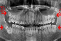 2020 04 27 17 41 8320 2020 04 28 Kissing Molars 20200427172715