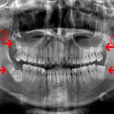 2020 04 27 17 41 8320 2020 04 28 Kissing Molars 20200427172715