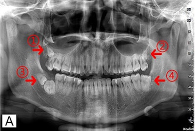 Pretreatment panoramic tomogram shows three supernumerary teeth in all four quadrants. Arrowheads labeled one and two show two supernumerary teeth located at the root tip of the third molar. Arrowhead three shows supernumerary teeth were relatively close to the adjacent molar and had an odd orientation. Arrowhead four shows the third molar had a square-shaped crown and a very short root. Image courtesy of An Lao, DMD; Siyuan Bi, DDS; Haoran Cheng, DDS, MD; Tiehan Lai, DDS; Shengbin Huang, DDS; and Shufan Zhao, DDS. Licensed under CC BY-NC 4.0.