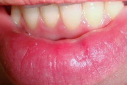 2020 04 28 22 47 1553 2020 04 30 Lip Lesions Laser 20200428225824