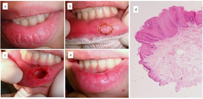 Image (a) shows the recurrent white lesion on the patient's lip. Image (b) shows the preliminary safe margins of excision by diode laser. Image (c) shows the deep surgical wound left immediately after laser treatment, and image (d) shows the histological exam leading to the frictional keratosis diagnosis. Image (e) shows the complete mucosal healing 14 days after the procedure. All images courtesy of Domenico De Falco, faculty of dentistry, et al. Licensed under CC BY-NC 4.0.