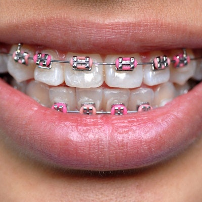 2018 09 28 18 50 4194 Braces Pink Bands 400