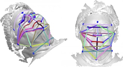 Linear and geodesic measurements from 3D photographs could predict OSA likelihood. Image courtesy of the Journal of Clinical Sleep Medicine.