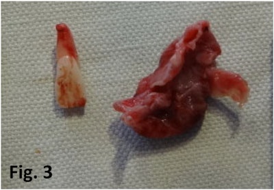 The removed displaced tooth and its fibrous capsule. Image courtesy of SJ Shah et al. Licensed under CC BY-NC 4.0