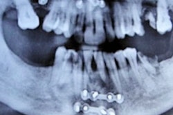 2020 05 01 22 30 4772 2020 05 05 Displaced Tooth 400