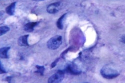 2020 05 05 16 03 1894 2020 05 06 Amoeba Gum Disease 20200505164644