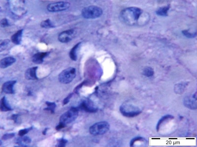 The parasite E. gingivalis penetrates gum tissue and feeds on host cells. Image courtesy of Arne Schäfer, PhD, and Charité's Institute of Dental and Craniofacial Sciences.