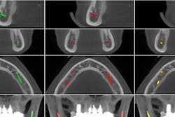 2020 05 12 18 15 9505 2020 05 13 Ai Mandibular Canal Scans 20200512181947