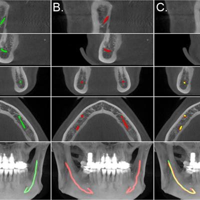 2020 05 12 18 15 9505 2020 05 13 Ai Mandibular Canal Scans 20200512181947