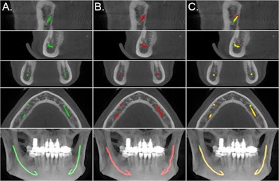 Comparison of the model segmentation and the ground truth, from the secondary test data annotations, for a CBCT scan. A: The green lines show the segmentation of the model. B: The red lines indicate the interpolated control point annotation. C: The yellow lines represent the overlap between the model segmentation and the annotation. Image courtesy of Joel Jaskari et al. Licensed under CC BY-NC 4.0.