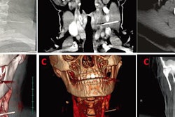 2020 05 18 18 04 7095 2020 05 19 Xray Swallowed Needle 20200518185136