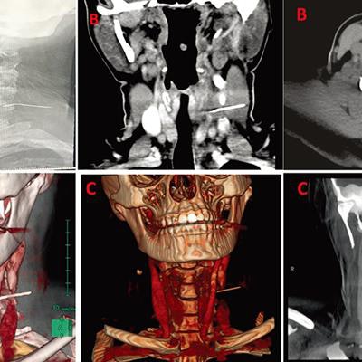 2020 05 18 18 04 7095 2020 05 19 Xray Swallowed Needle 20200518185136