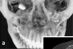 2020 05 19 16 43 7633 2020 05 20 Ectopic Tooth Cbct 20200519164454