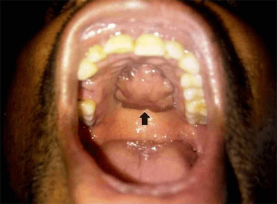 Hard palate growth upon intraoral clinical inspection. All images courtesy of Sonam Sharma, MD, et al. Licensed under CC BY-NC 4.0.