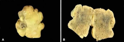 Figure A is the macroscopic decalcified specimen removed from the oral cavity. Figure B shows the yellow-gray hard cut surface of the tumor.