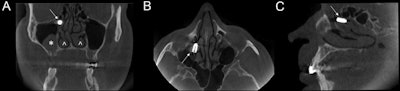 CBCT images in coronal (A), axial (B), and sagittal (C) sections show the implant located at the ethmoidal infundibulum level of the right maxillary sinus. The asterisk shows a mucus retention cyst in the right maxillary sinus. The arrowheads show the asymmetry of inferior turbinates, which may be due to compensatory hypertrophy after the right septal deviation. Image courtesy of Filippo Cascio, MD, et al. Licensed under CC BY-NC 4.0.