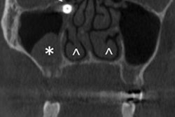 2020 06 04 20 19 1533 2020 06 05 Dislocated Implant Ct Large 20200604200826