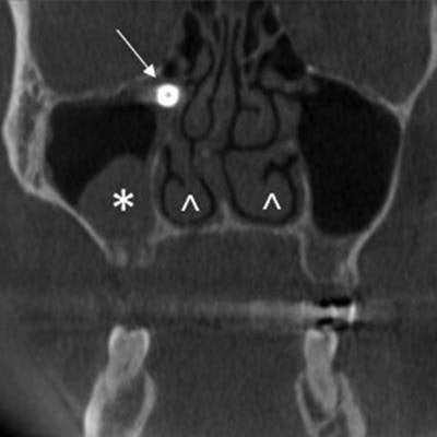 2020 06 04 20 19 1533 2020 06 05 Dislocated Implant Ct Large 20200604200826