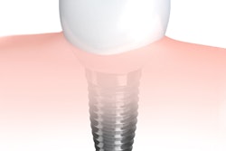 2018 10 24 20 58 3247 Implant2 400