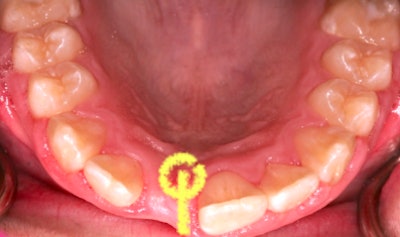 Mouth showing missing tooth