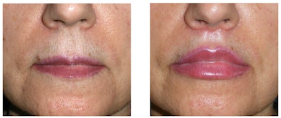 Before and after lip treatment by plastic surgeon
