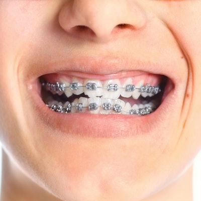 2020 07 20 14 01 0427 Braces2 400