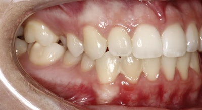 Image of teeth before treatment