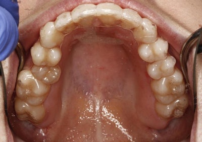 Image of teeth after five months