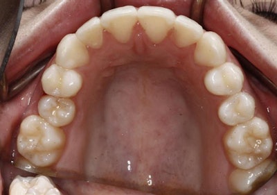Image of teeth after treatment