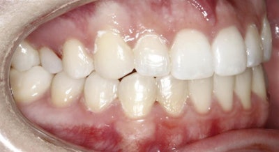 Image of teeth after treatment