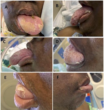 How the patient's macroglossia resolved over time with lingual compression. (A) The first day of treatment prior to wrapping the tongue. (B) The third day of treatment. (C) The fourth day of treatment. (D) The 10th day of treatment. (E) The 13th day of treatment. (F) The 14th day of treatment.