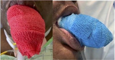 View of the lingual compression wrap. All images courtesy of Adam M. Ackerman, MD, et al.