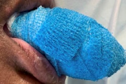 2020 07 23 22 36 7353 2020 07 27 Covid Tongue Before 400