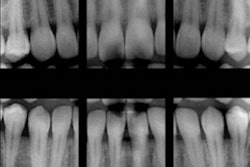 2018 08 14 19 13 2914 X Ray Dental Digital Bitewings 400