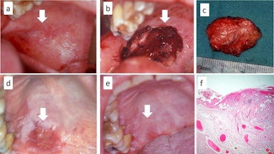 A: A malignant transformation of proliferative verrucous leukoplakia of the soft palate. B and C: The entire lesion was excised with the laser without direct suture of the margins. D: A view of the partially healed lesion. E: Complete healing of the palate after 22 days. F: The histological exam shows foci of early oral squamous cell carcinoma.