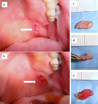 A: Small nodular lesion within a larger white lesion of the patient's posterior soft palate. B. After the lesion was removed by a diode laser. C-E: Various images of the surgical specimen, which is well conserved and shows no sign of carbonization, which can affect histological readability. All images courtesy of DeFalco et al. Licensed under CC BY-NC 4.0.
