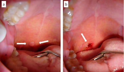 A: A viral papilloma of the posterior soft palate. B: The site after the papilloma was removed with a diode laser.