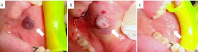 A: A blue-violet appearance of a venous malformation of the cheek mucosa. B: The diode laser confirmed transmucosal photocoagulation when the malformation changed color to grayish-white. C: The irradiated area healed in 14 days.