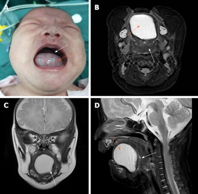The girl prior to her first surgery. A: The white arrow shows her raised tongue in the retracted position. The orange arrow indicates the large-sized cystic mass protruding from her mouth. B: MR imaging reveals a large lesion (orange arrow) and a small suspect lesion (white arrow). C: View in coronal plane of a cystic lesion. D: View in sagittal plane of large (orange arrow) and tiny suspect lesions (white arrow). All images courtesy of Zhi-Ming Wang, DDS, MD, PhD, et al. Licensed under CC BY-NC 4.0.