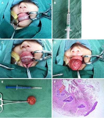 The girl during her first surgery. A: Contracted lesion and lowered tongue after clear fluid was aspirated (white arrow at shrunken mass). B: Clear fluid withdrawn. C: Horizontal incision made. D: Dissection of cyst from surrounding tissues. E: Removed cyst. F: Histology revealed keratinizing stratified squamous epithelial lining (white arrows) and sebaceous glands (orange arrows).