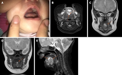 The infant three days after surgery. A: Edema at the incision site. B: Postoperative MRI shows two cystic lesions (orange arrows) under her tongue. C and D: View of each lesion in coronal plane (orange arrow). E: Both lesions in sagittal plane (orange arrows).